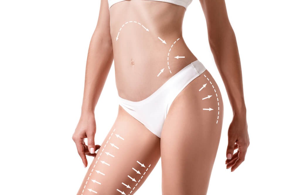 3D FULL BODY LIPOSUCTION