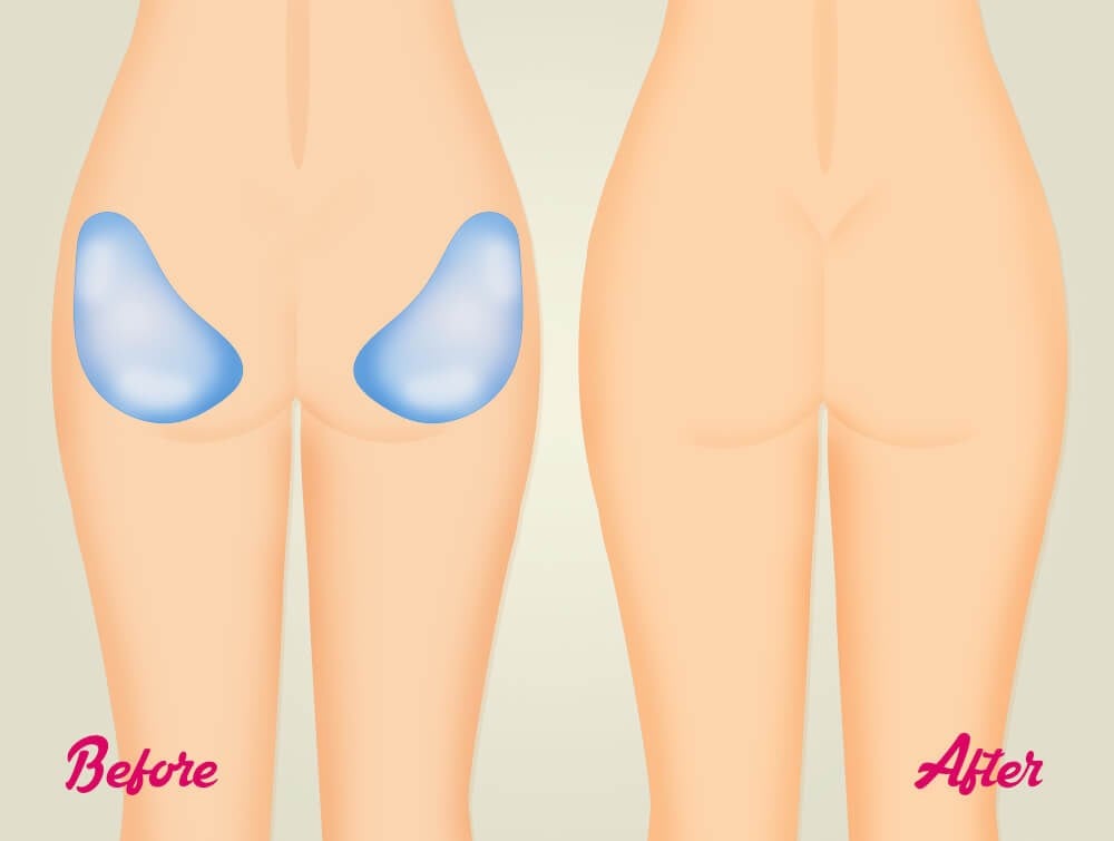 5 Tips to Recover Quickly from Butt Augmentation Surgery in Las Vegas 5  Tips to Recover Quickly from Butt Augmentation Surgery