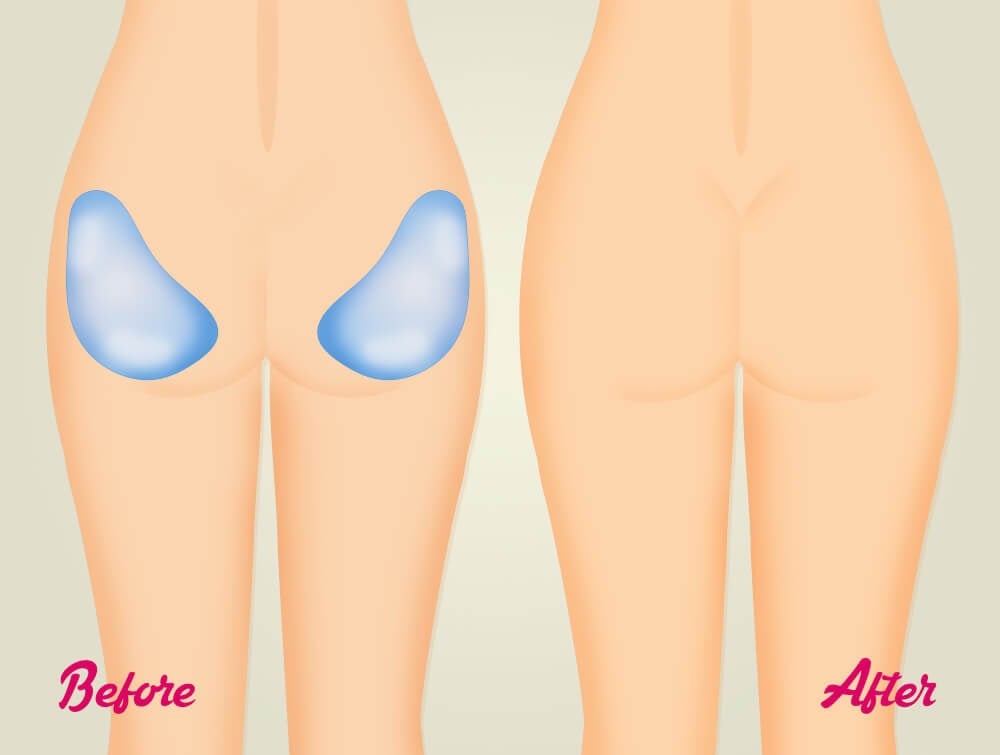 Buttocks surgery: buttock lift, body lift, buttock implants and