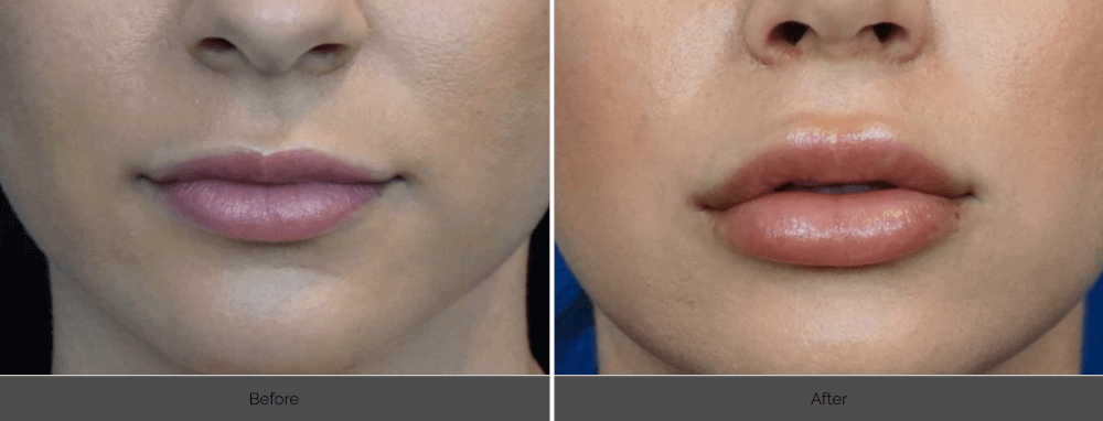 From Simple To Sexy. How Lip Fillers Can Give You The Lips You Desire